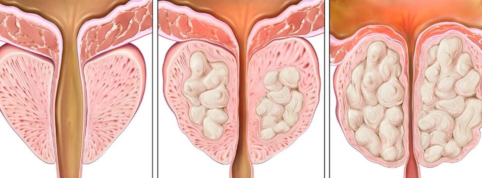 Prostatitis stages